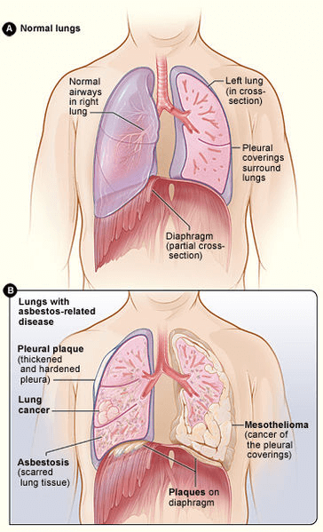 mesothelioma and asbestosis effects