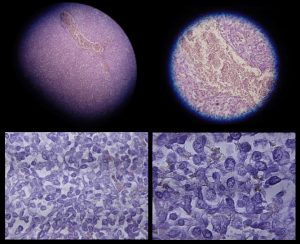 mesothelioma cells in body